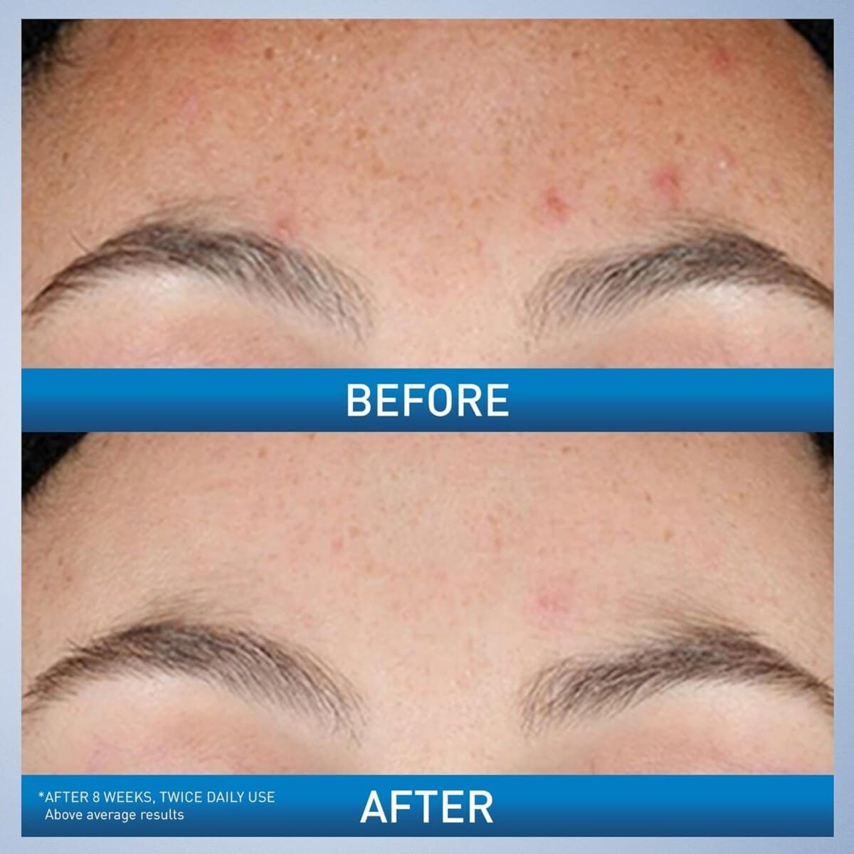 CeraVe Resurfacing Retinol Serum For Post Acne Marks Formulated With Licorice Root Extract Niacinamide Brightening Serum Pore Minimizer For Face Post Acne Skin Barrier Repair Non-Comedogenic - 30ml